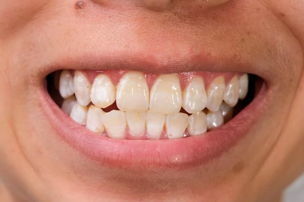 teeth with calcium spot