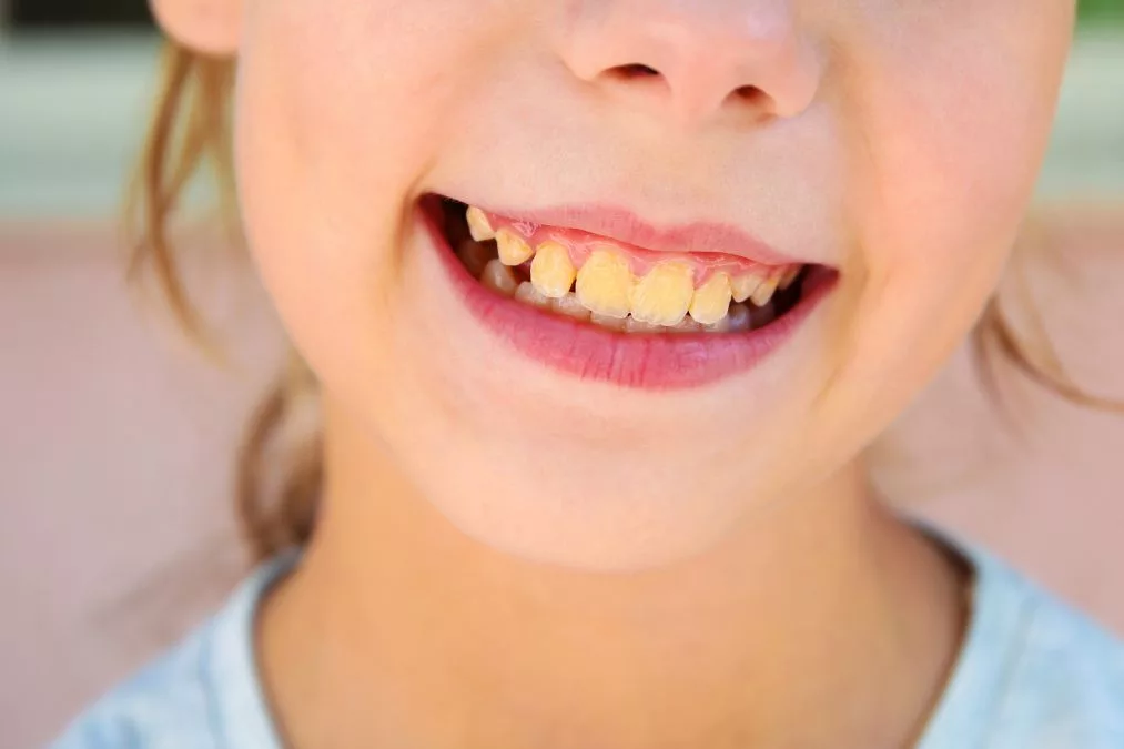 girl with yellow stain teeth