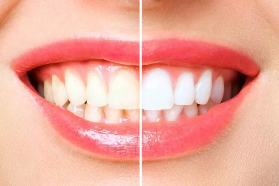 teeth whitening before and after 
